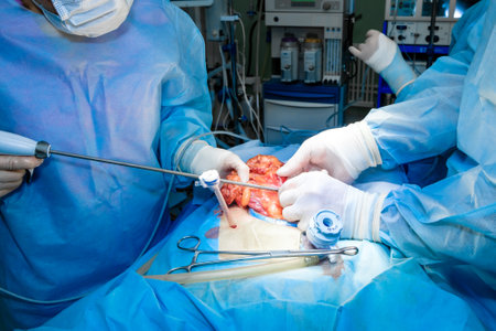 A team of surgeons in sterile gloves and a surgical uniform uses laparoscopic surgical instruments during surgery. Selective focus.の写真素材
