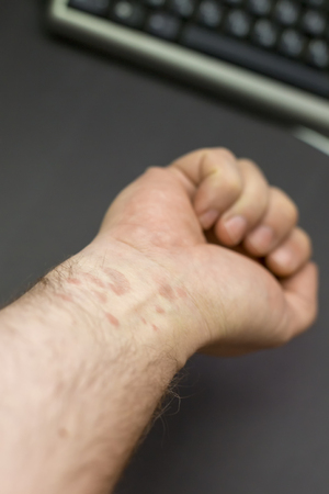 Disease of the skin on the hands of dermatitis. Disease of the skin in the form of large red spots on the hand of a manの写真素材