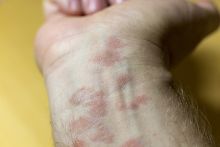 Human skin in red spots. Closeup of red inflamed disease spots on the hands of a man.の写真素材