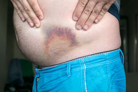 Bruise, hematoma on human body. Large bruise, bruise on the stomach of a man after injury.の写真素材