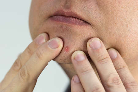 A large ripe pimple on a man's face, close-up.の写真素材