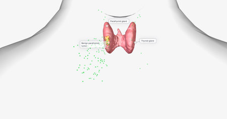 Hyperparathyroidism is a condition in which high amounts of parathyroid hormone are produced by the...