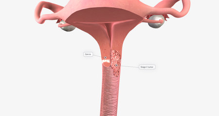 In stage II, the cancer has invaded the upper part of the vagina and tissue near the uterus called the parametrium.3D renderingの写真素材