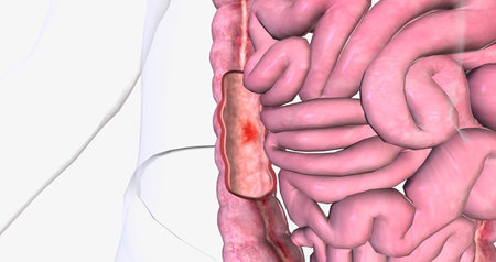 Angiodysplasia of the colon is swollen, fragile blood vessels in the colon. 3D rendering