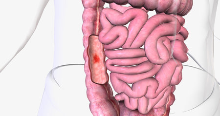 Angiodysplasia of the colon is swollen, fragile blood vessels in the colon. 3D renderingの写真素材