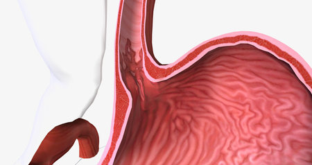 Barretts esophagus is a condition in which the tissue lining the esophagus is replaced by tissue that is similar to the intestinal lining. 3D renderingの写真素材