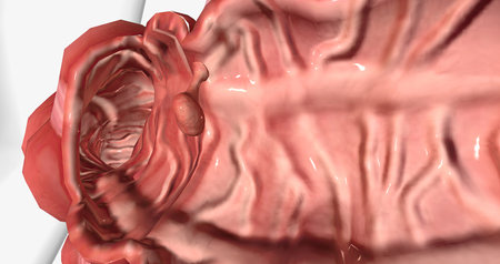 Adenomatous polyps are gland-like growths that develop on the mucous membrane lining the large intestine. 3D renderingの写真素材