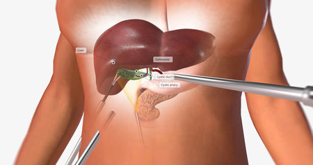Locating and Retracting the Gallbladder 3D renderingの写真素材