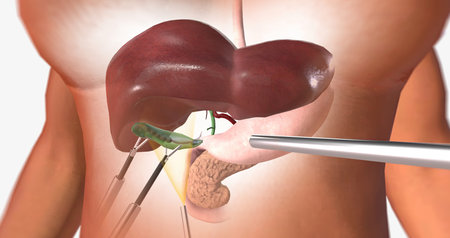 The Removal of the Gallbladder 3D renderingの写真素材