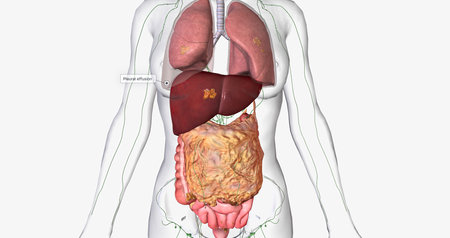 Stage IV ovarian cancer has spread to distant sites such as the lungs and liver. 3D renderingの写真素材