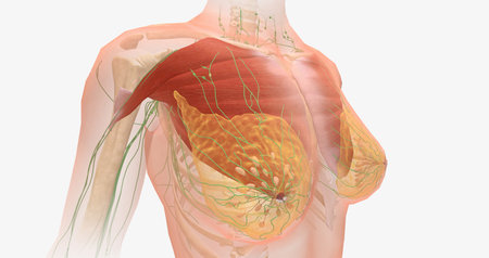 Stage II breast tumors are invasive. The tumor may have grown in size and spread to additional lymph nodes.3D renderingの写真素材