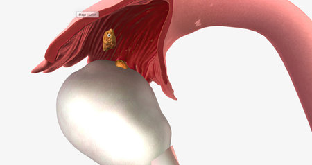 Stage I ovarian cancer has a detectable tumor and has spread to one or both the ovaries. 3D renderingの写真素材