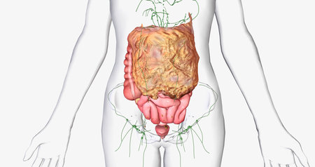 Stage III ovarian cancer has spread beyond the pelvis area to the abdomen. 3D renderingの写真素材
