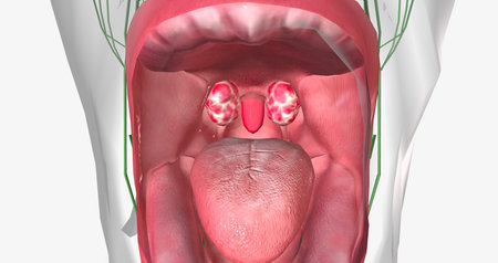 Strep throat is a common condition caused by a bacterial infection of the mouth and back of the oral...