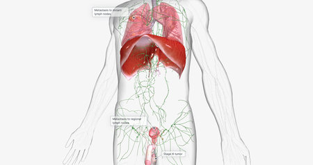 Stage III testicular cancer is characterized by spread to distant lymph nodes. 3D renderingの写真素材