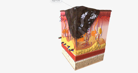 The In Stage III ALM Acral Lentiginous Melanoma 3D renderingの写真素材