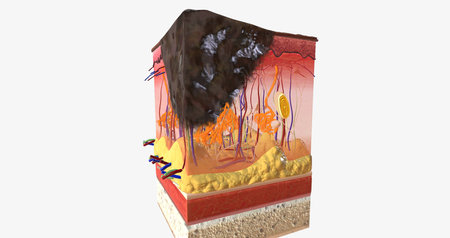 The In Stage III ALM Acral Lentiginous Melanoma 3D renderingの写真素材