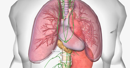 In stage III esophageal cancer, the tumor has spread through the layers of the esophageal wall. 3D renderingの写真素材