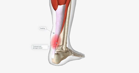 An ankle strain occurs when the muscles or tendons around the ankle are stretched too far. 3D renderingの写真素材