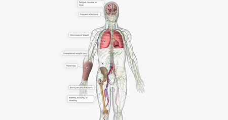 The AML, Signs and Symptoms 3D renderingの写真素材