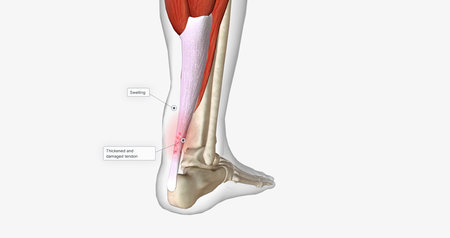 An ankle strain occurs when the muscles or tendons around the ankle are stretched too far. 3D renderingの写真素材