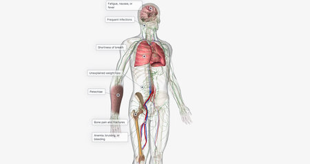 The AML, Signs and Symptoms 3D renderingの写真素材
