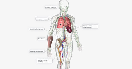 The CML, Signs and Symptoms 3D rendering