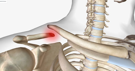 A clavicle fracture is a break in the collarbone, one of the bones in the shoulder.3D renderingの写真素材