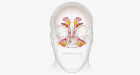 Sinusitis is an infection characterized by inflammation of the paranasal sinuses and excess mucus...