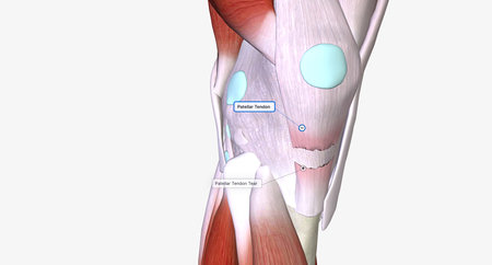 When a tendon is weakened by age or overuse, trauma can cause it to rupture.3D renderingの写真素材
