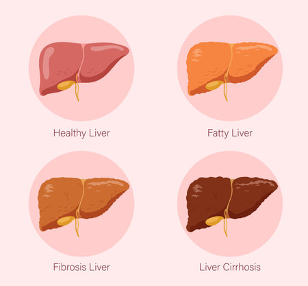 Illustration showing healthy liver, fatty liver, fibrosis liver, and liver cirrhosis on a pink background. Concept of liver health and disease progression. Vector illustrationのイラスト素材