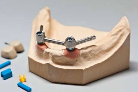 Dental implant. Dental implant teeth on skeletal mandible support.