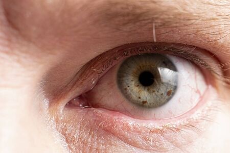 Sore eye with suppuration on eyelashes closeup