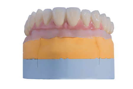 Gypsum model with artificial gum and implants placed in it and metal-ceramic bridge fixed on these...