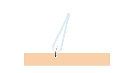 Illustration of tweezers and hair on the skin. Vector isolated editable flat illustrationのイラスト素材