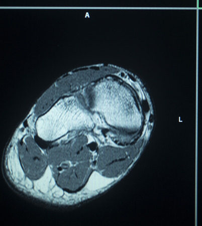 MRI magentic resonance imaging nuclear scanning scan test results foot toes injury photo.の写真素材