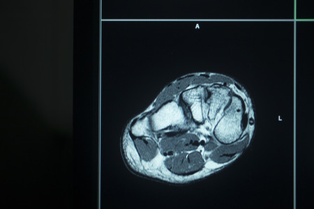 MRI magentic resonance imaging nuclear scanning scan test results foot toes injury photo.の写真素材