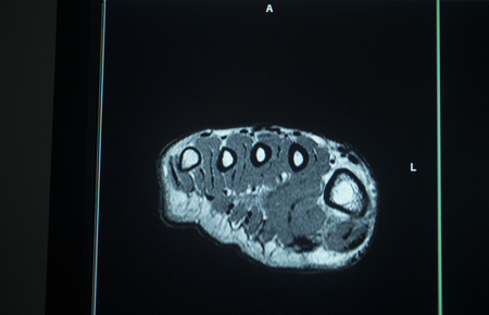 MRI magentic resonance imaging nuclear scanning scan test results foot toes injury photo.の写真素材