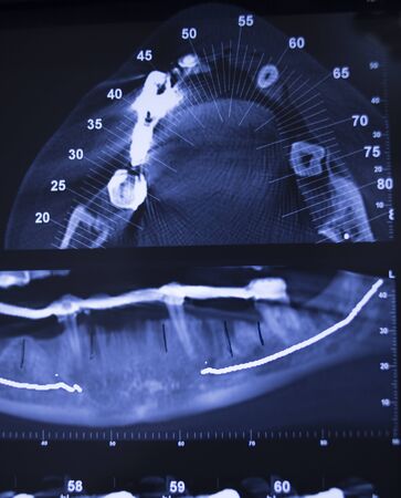 Dentist dental tooth xray scan results on light viewing screen photo.の写真素材