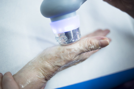 Electro stimulation used to treat pain, muscles injuries, strains and tension in hospital physiotherapy medical rehabilitation clinic for patient hand.の写真素材