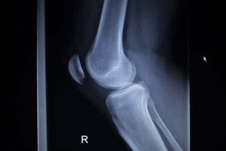 X-ray orthopedic medical CAT scan of painful knee meniscus injury leg in traumatology hospital clinic.の写真素材