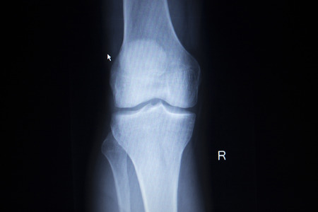 X-ray orthopedic medical CAT scan of painful knee meniscus injury leg in traumatology hospital clinic.の写真素材