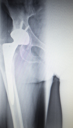 X-ray scan  image of hip joints with orthopedic hip joint replacement implant head and screws in human skeleton in blue gray tones. Scanned in orthopedics traumatology surgery hospital clinic.の写真素材