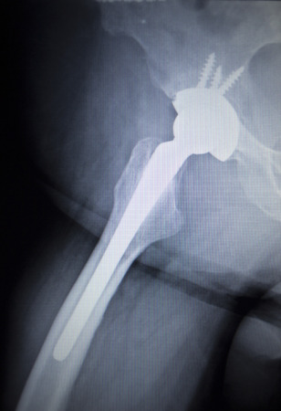 X-ray scan  image of hip joints with orthopedic hip joint replacement implant head and screws in human skeleton in blue gray tones. Scanned in orthopedics traumatology surgery hospital clinic.の写真素材