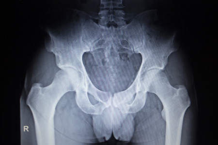 X-ray scan  image of hip joints human skeleton in blue gray tones. Scanned in orthopedics traumatology surgery hospital clinic.の写真素材