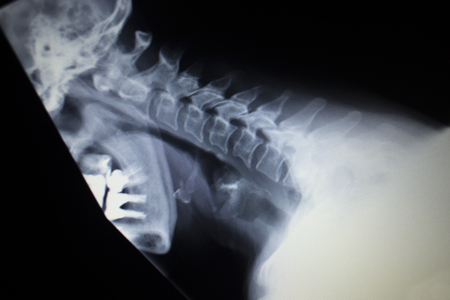 X-ray orthopedic medical CAT scan of painful neck injury in Traumatology hospital clinic.
