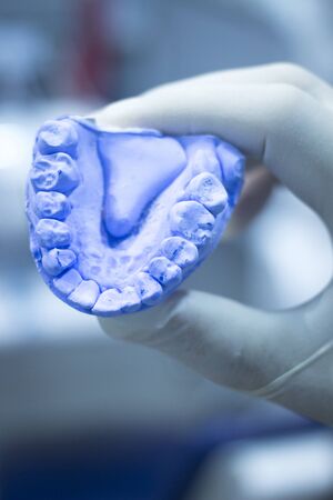 Dental mold dentist clay teeth plate ceramic cast model showing tooth decay of patient in dental...