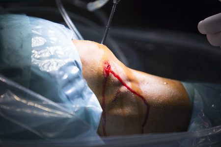 Traumatology orthopedic surgery hospital emergency operating room prepared for knee torn meniscus arthroscopy operation photo of drip fluids tube, arthroscope, arthroscopy camera and probe.の写真素材