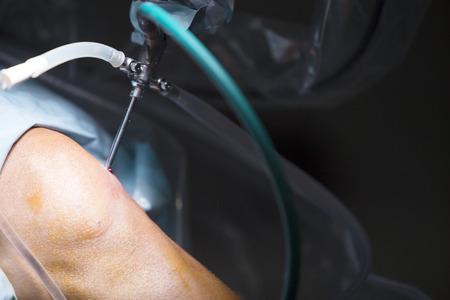 Traumatology orthopedic surgery hospital emergency operating room prepared for knee torn meniscus arthroscopy operation photo of drip fluids tube.の写真素材