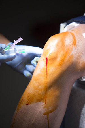 Traumatology orthopedic surgery hospital emergency operating room prepared for knee torn meniscus arthroscopy operation photo anaesthetic injection.の写真素材
